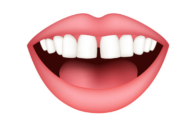 ayrık diş tedavisi