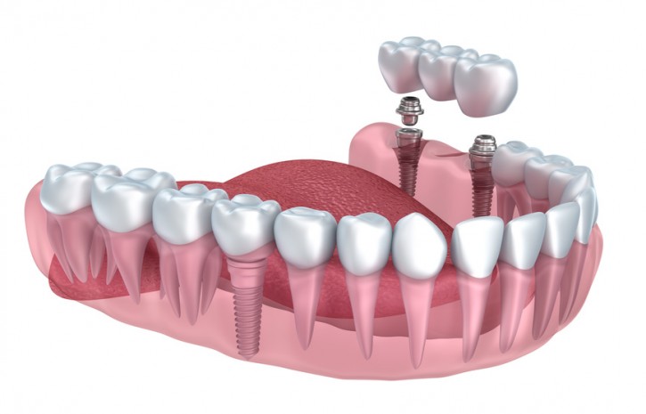 implant diş nedir