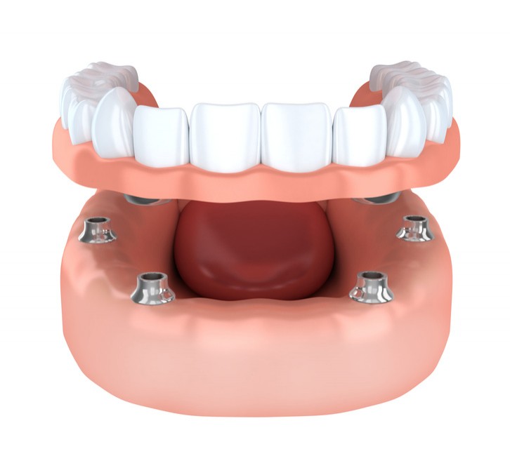 implant üstü protez damak diş