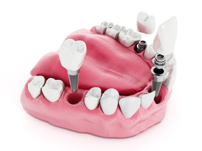 implant tek diş