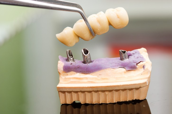 zirconia crown over dental implant
