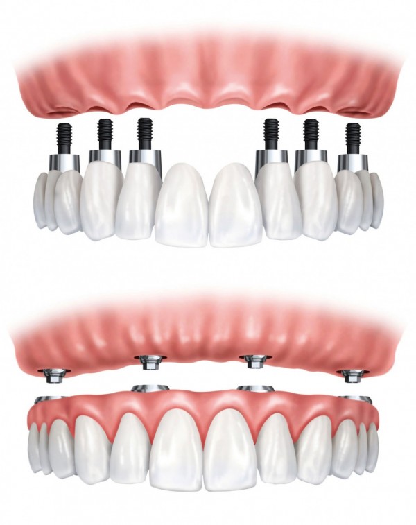 History of Dental Implants