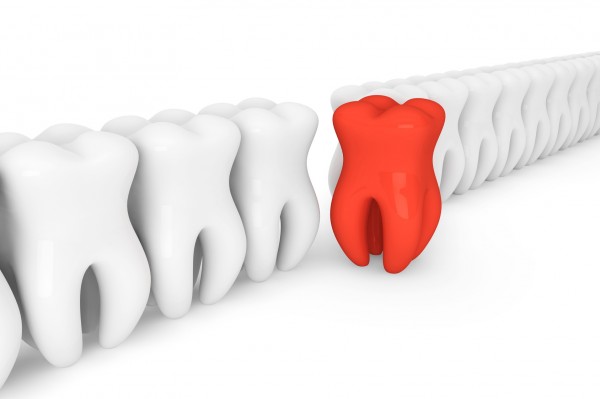 Diş Çürükleri Nasıl Önlenir?
