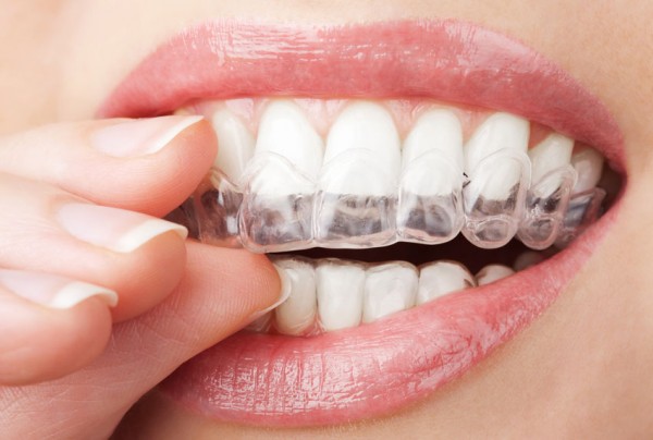 Estetik Ortodonti : Şeffaf Diş Teli, Aparey ve Lingual 