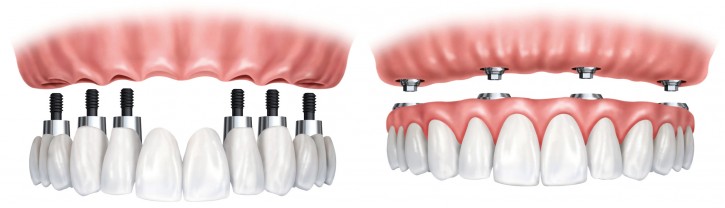 full implant diş ve implant üstü protez 