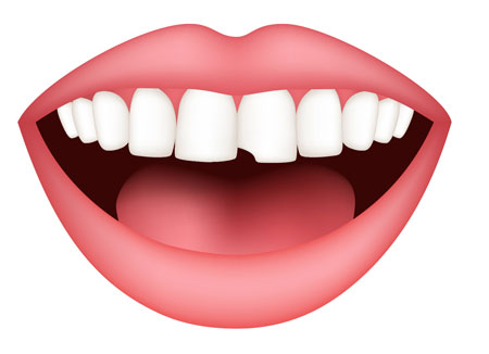 kırık diş tedavisi