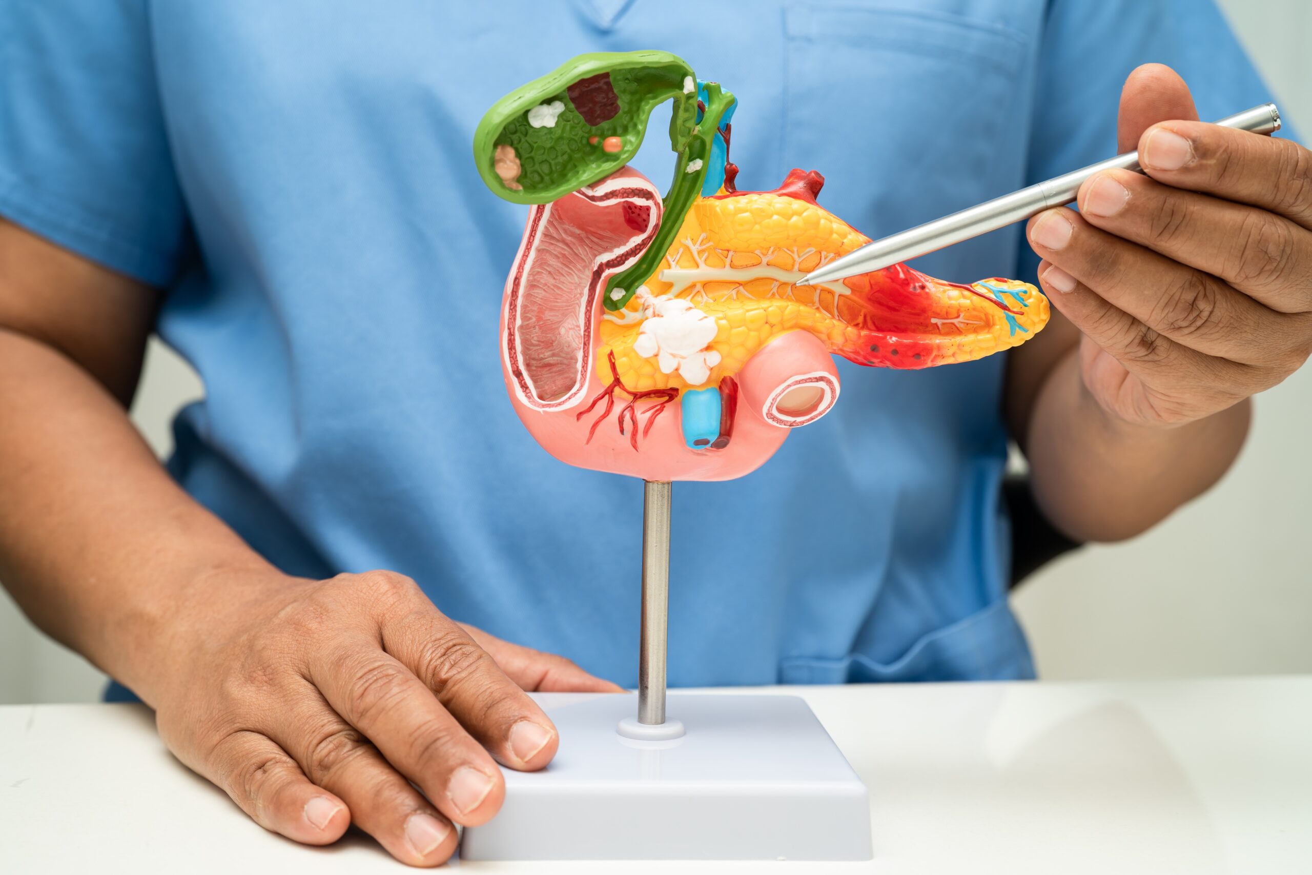 Pancreatitis, pancreatic cancer, Asian doctor with pancreas, gallbladder, and bile duct human