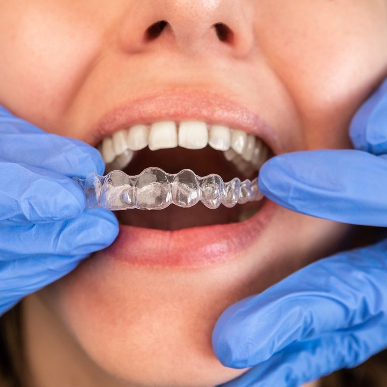 Dentist in gloves applying invisible aligner on female patient teeth at modern clinic. Orthodontic removable straighteners in dentist office. Dental treatment concept.