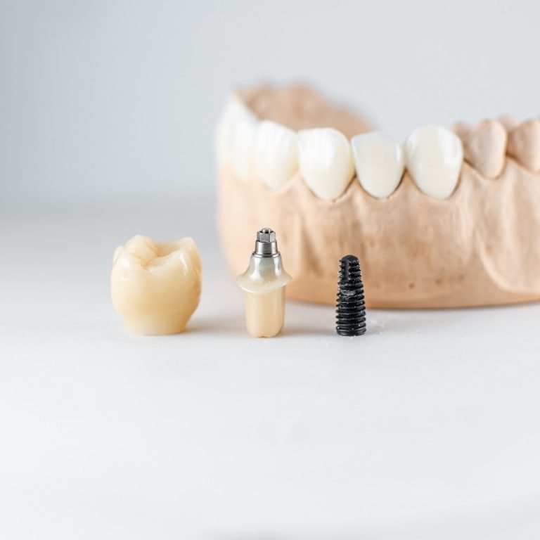 Close-up on plaster model of artificial jaw and dental implant on the white background. Concept of prosthetics and implantation in dentistry